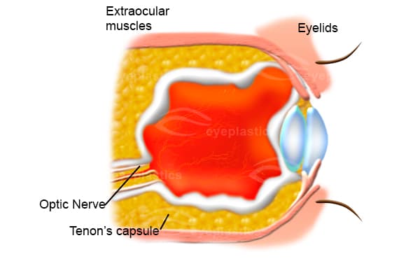 Healed anophthalmic socket before prosthetic fitting