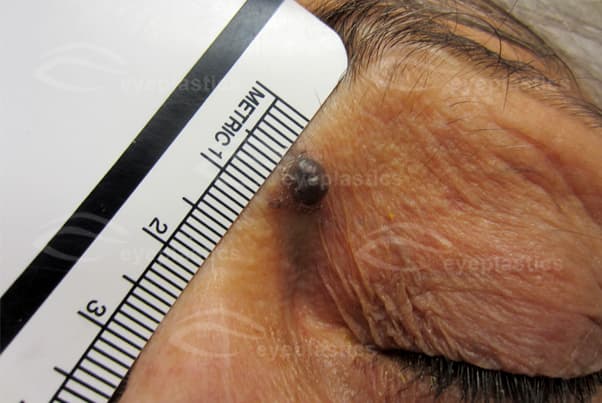 Basal cell carcinoma of the eyelid with pearly rolled border