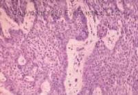Basal cell carcinoma histopathology showing basaloid islands with peripheral palisading