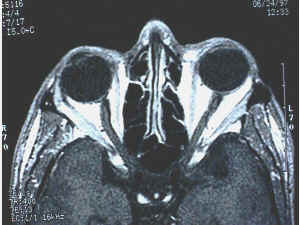 Axial CT scan of the orbit showing bony walls