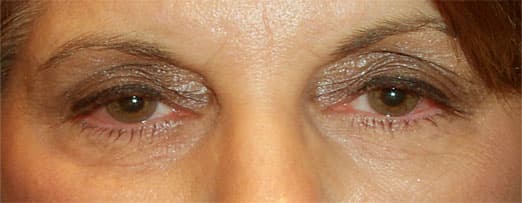 Before — Ptosis Repair · Age 53