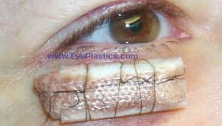 Basal cell carcinoma near the medial canthus
