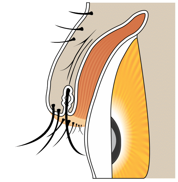 Diagram of distichiasis with an extra posterior row of lashes